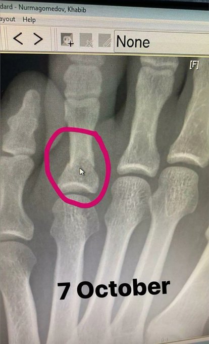 Сломанный палец Хабиба