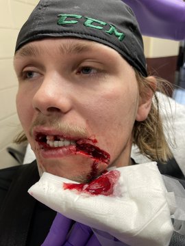 Российский хоккеист из НХЛ получил жуткую травму